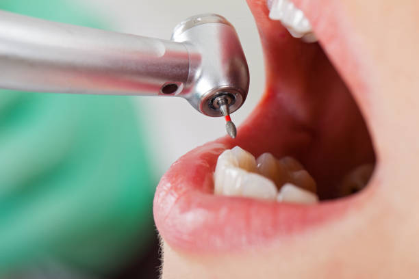 Best Emergency Root Canal Treatment in Laguna Heights, TX